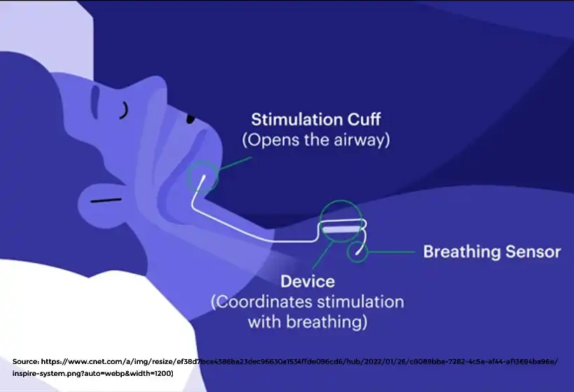 Inspire Sleep Apnea Treatment Work