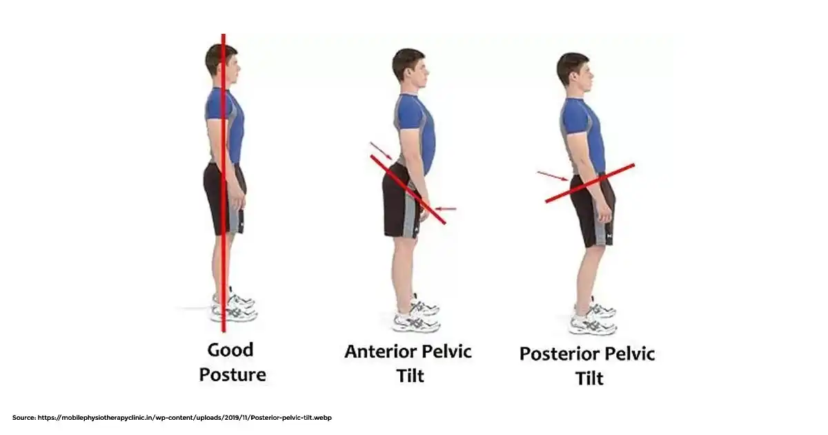 Best Mattress for Posterior Pelvic Tilt